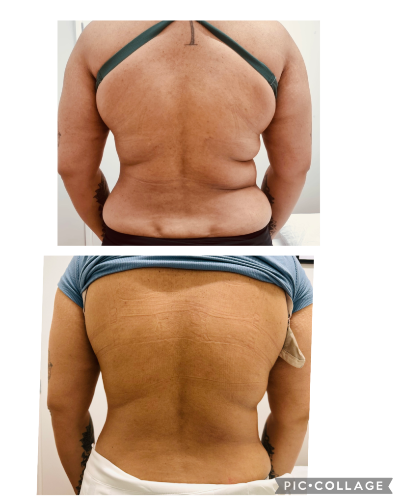 Fat freezing - Figureit Laser Clinic